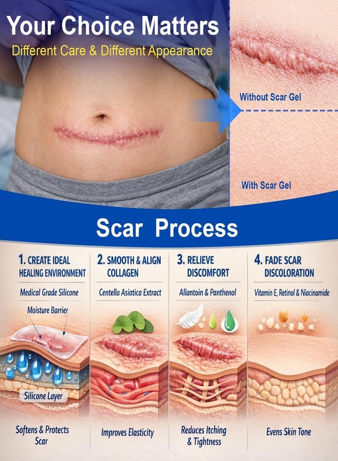 موروفان جل موروفان لإزالة الندبات بالسيليكون: كريم للندبات للجسم والوجه، يقلل بشكل فعال من ظهور الندبات الناتجة عن علامات التمدد، والندبات الجراحية، والجُدرات، وحب الشباب، والحروق، وغيرها. يُظهر الندبات الجديدة خلال 6 أسابيع. - Image 2